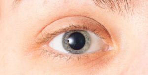 midriasis-pupila-dilatada
